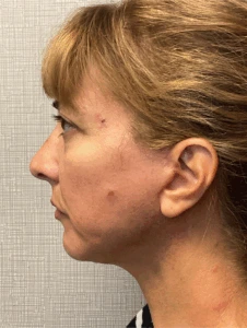 Facelift-Case--8368 | After Face 2