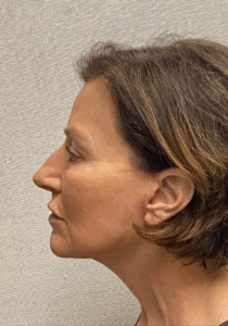 Facelift-Case--6591 | After Face 2