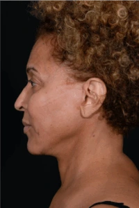 Face-and-Neck-Lift-Case--3772 | After Face 2