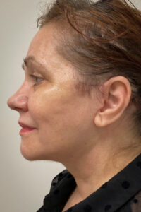 Necklift-Case--1496 | After Neck Lift 1