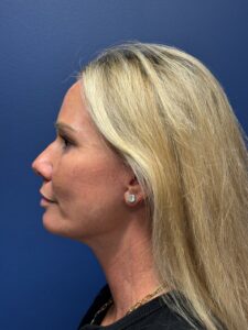 Facial-Fat-Grafting-Case--1028 | After Facial Fat Grafting 2