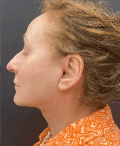Face-and-Neck-Lift-Case--8423 | After Dr. Arjun Kanuri 2