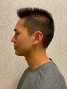 Otoplasty-Case--2681 | After Otoplasty 2