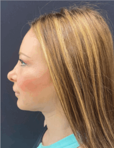Facial-Fat-Grafting-Case--1679 | After Facial Fat Grafting 2