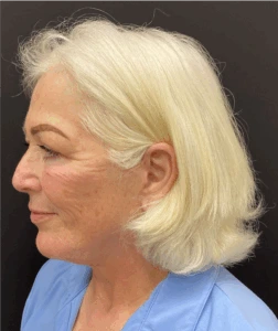 Necklift-Case--7769 | After Face 2