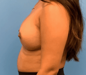 Breast-Augmentation-Case--1115 | After Dr. Arjun Kanuri 2