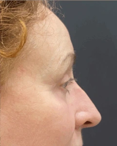 Blepharoplasty-Case--9685 | After Face 2