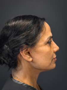 Facial-Fat-Grafting-Case--8416 | After Facial Fat Grafting 2