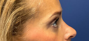 Quad-Blepharoplasty-Case--1261 | After Eyelid Surgery 2