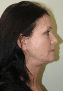 Face-and-Neck-Lift-Case--9403 | After Face 2