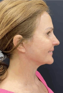 Facelift-Case--4160 | After Face 2