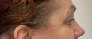 Quad-Blepharoplasty-Case--1851 | After Eyelid Surgery 1