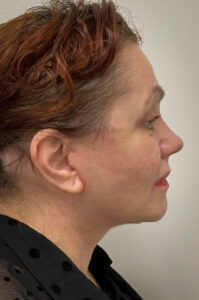 Necklift-Case--1496 | After Neck Lift 2