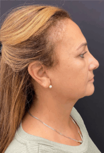 Necklift-Case--4869 | After Neck Lift 2