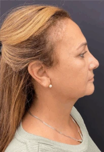 Necklift-Case--4869 | After Face 2