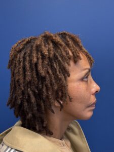 Facelift-Case--1863 | After Facelift 2