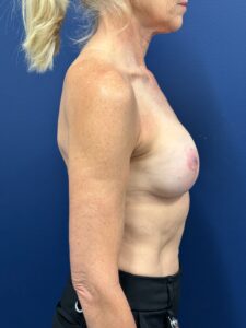 Augmentation-Mastopexy-Case--1505 | After Breast Augmentation With Lift 2