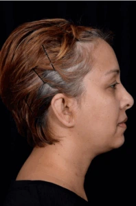 Otoplasty-Case--4655 | After Face 2