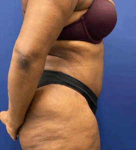 Abdominoplasty-Case--4427 | After Body 2