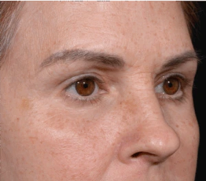 Quad-Blepheroplasty-Case--5361 | After Face 2
