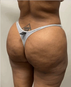 Brazilian-Butt-Lift-Case--7979 | After Body 2