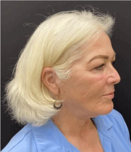 Facelift-Case--8874 | After Face 2