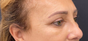 Quad-Blepharoplasty-Case--2302 | After Eyelid Surgery 2