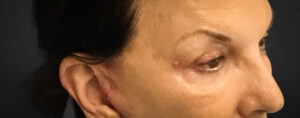 Upper-Blepharoplasty-Case--2075 | After Eyelid Surgery 2