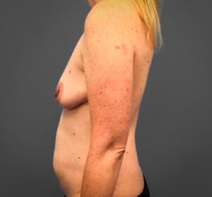 Before Breast Augmentation (Side)