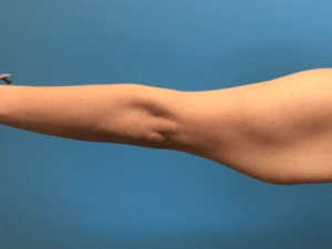 Brachioplasty-Case--276 | Before Body 1