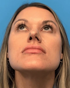 Rhinoplasty-Case--23703 | Before Face 2