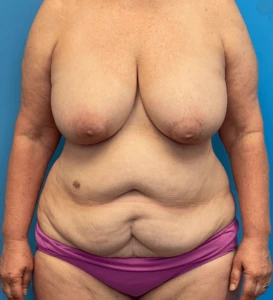 Mommy-Makeover-Case--27387 | Before Body 1