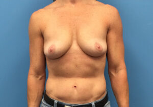 Augmentation-Mastopexy-Case--230 | Before Breast Augmentation With Lift 1