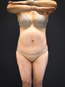 Tummy-Tuck-Case--5969 | Before Tummy Tuck 1