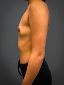 Breast-Augmentation-Case--4631 | Before Breast Augmentation 2