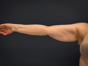 Brachioplasty-Case--3119 | Before Arm Lift 1