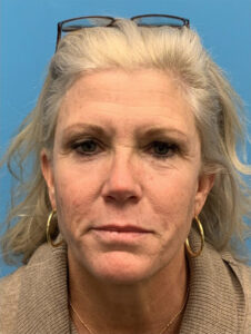 Face-and-Neck-Lift-Case--15055 | Before Face360 1