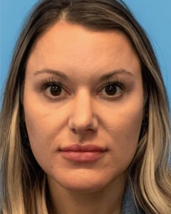 Rhinoplasty-Case--23703 | Before Face 1