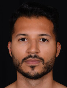 Rhinoplasty-Case--379 | Before Rhinoplasty for Men 1