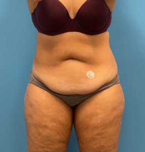 Lipoabdominoplasty-Case--25555 | Before Liposuction 1