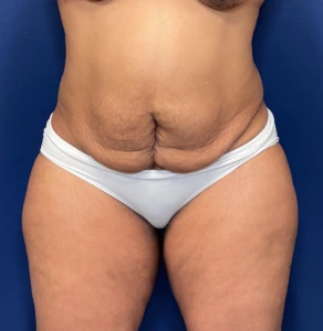 Liposuction-Case--254 | Before Body 1