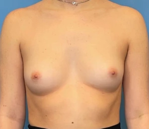 Breast-Augmentation-Case--224 | Before Breast Augmentation 1