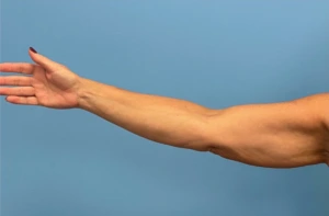 Before right arm profile of patient before undergoing brachioplasty procedure