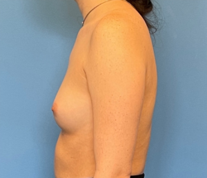 Breast-Augmentation-Case--224 | Before Breast Augmentation 2