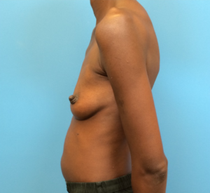 Case--97 | Before Breast Augmentation 2