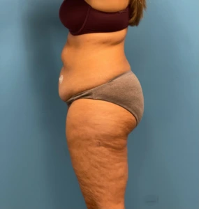 Lipoabdominoplasty-Case--25555 | Before Body 2