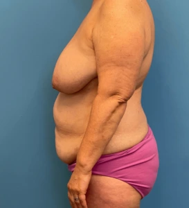 Mommy-Makeover-Case--27387 | Before Body 2
