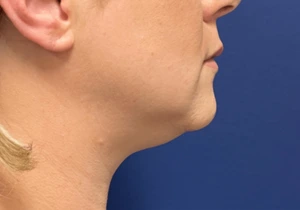 Case--20811 | Before Face 2