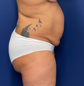 Liposuction-Case--254 | Before Liposuction 2