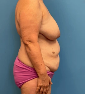 Lipoabdominoplasty-Case--24903 | Before Body 2